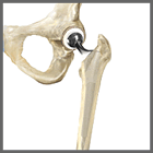 Total Implanted
